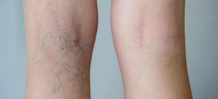 Spider veins can be treated with sclerotherapy